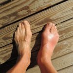 Natural Remedies for Gout: From Cherry Juice to Epsom Salt Baths