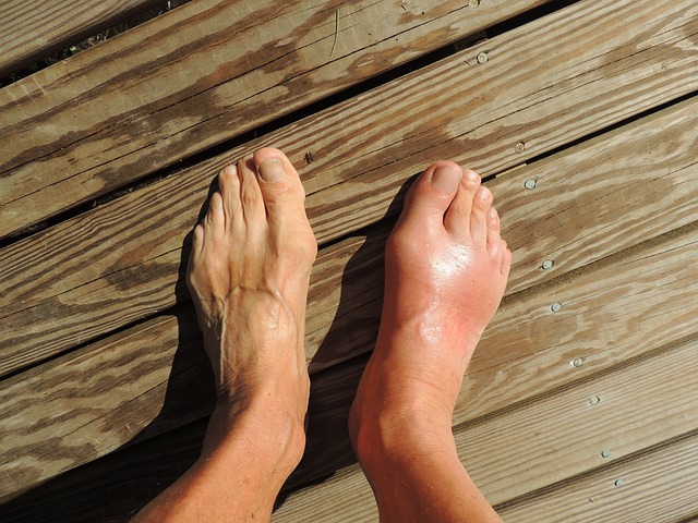 feet gout