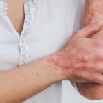 What Clears Psoriasis Fast?