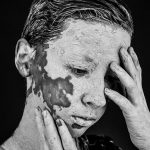 Living with Vitiligo: Coping Strategies and Treatment Options