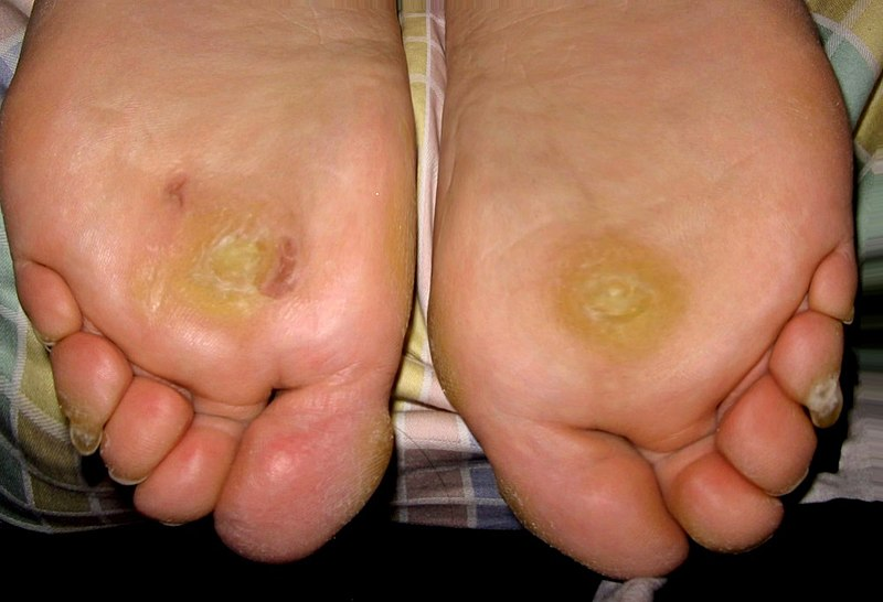 How Do You Dissolve Warts Naturally?